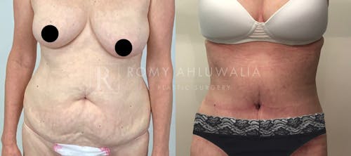 Before & After Result of Tummy Tuck Patient #16