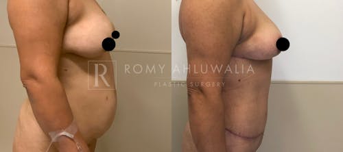 Before & After Result of Tummy Tuck Patient #5
