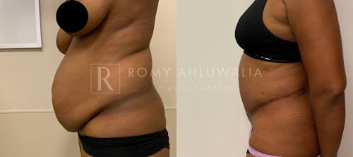 Before & After Result of Tummy Tuck Patient #17