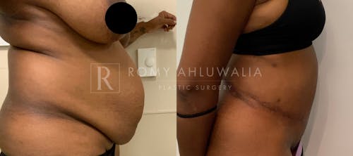 Before & After Result of Tummy Tuck Patient #17