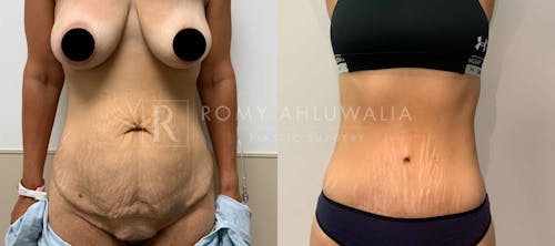 Before & After Result of Tummy Tuck Patient #18