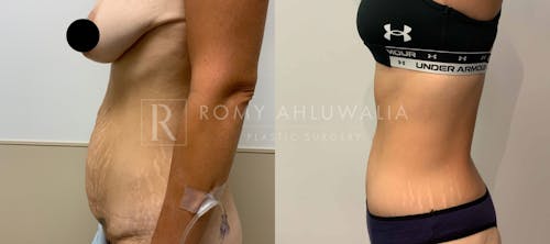 Before & After Result of Tummy Tuck Patient #18