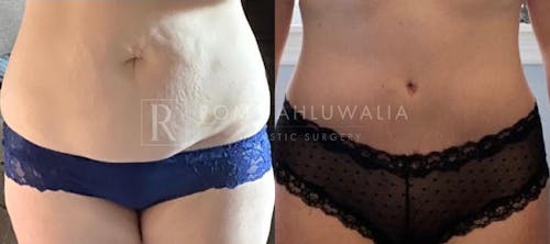 Before & After Result of Tummy Tuck Patient #19