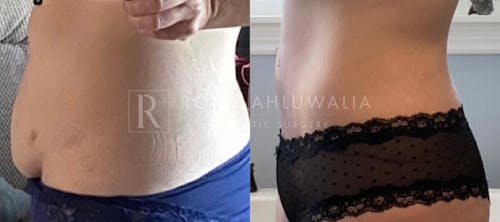 Before & After Result of Tummy Tuck Patient #19