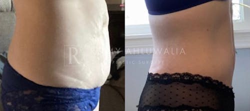 Before & After Result of Tummy Tuck Patient #19