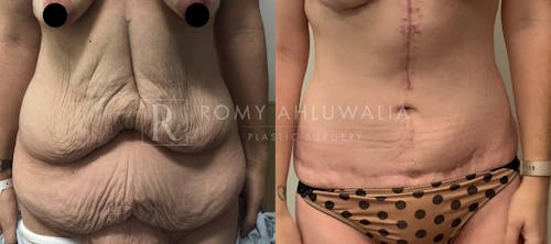 Before & After Result of Tummy Tuck Patient #20