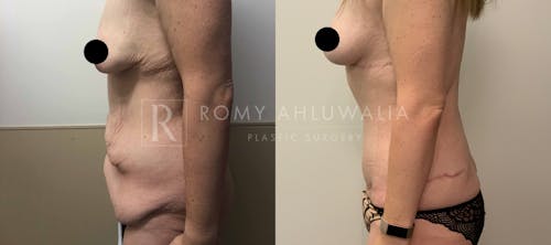 Before & After Result of Tummy Tuck Patient #20