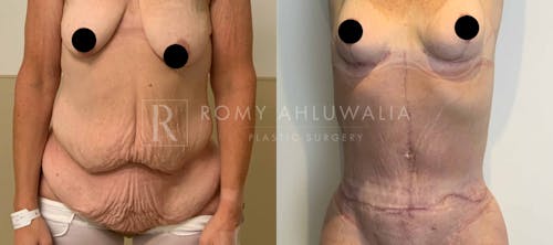 Before & After Result of Tummy Tuck Patient #21
