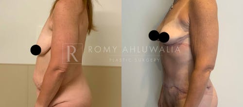 Before & After Result of Tummy Tuck Patient #21