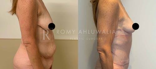 Before & After Result of Tummy Tuck Patient #21