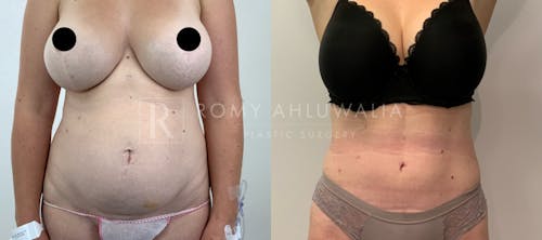 Before & After Result of Tummy Tuck Patient #22