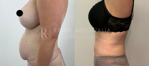 Before & After Result of Tummy Tuck Patient #22