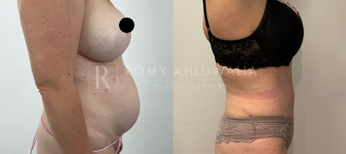 Before & After Result of Tummy Tuck Patient #22