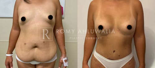 Before & After Result of Tummy Tuck Patient #23