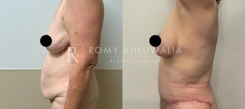 Before & After Result of Tummy Tuck Patient #24