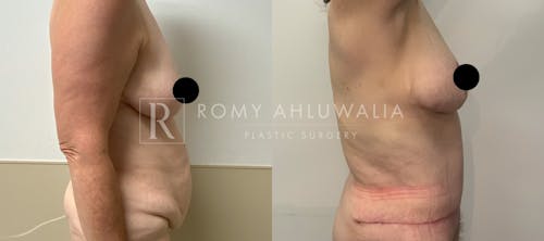 Before & After Result of Tummy Tuck Patient #24