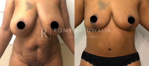 Before & After Result of Tummy Tuck Patient #25