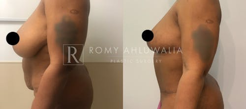 Before & After Result of Tummy Tuck Patient #25