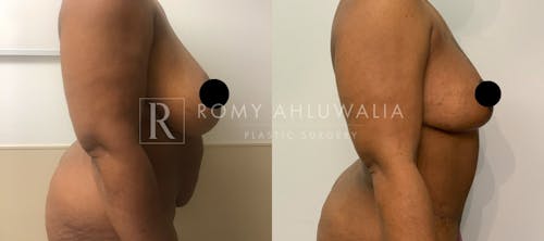 Before & After Result of Tummy Tuck Patient #25