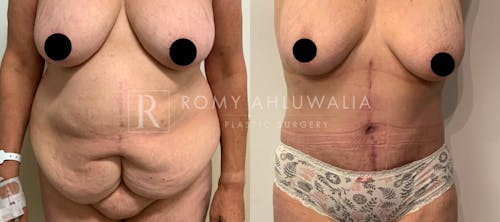 Before & After Result of Tummy Tuck Patient #26