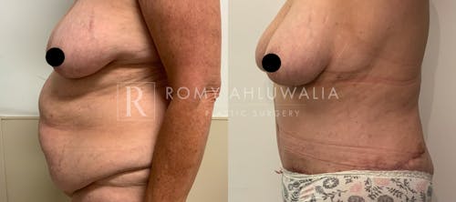 Before & After Result of Tummy Tuck Patient #26