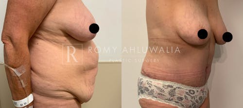 Before & After Result of Tummy Tuck Patient #26