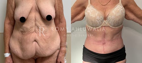Before & After Result of Tummy Tuck Patient #27