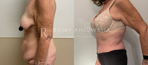 Before & After Result of Tummy Tuck Patient #27