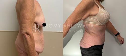 Before & After Result of Tummy Tuck Patient #27