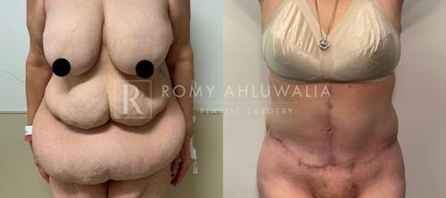 Before & After Result of Tummy Tuck Patient #29