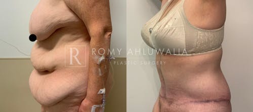 Before & After Result of Tummy Tuck Patient #29