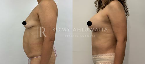 Before & After Result of Tummy Tuck Patient #31