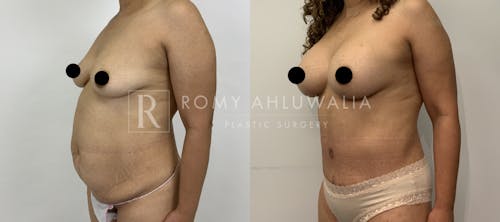 Before & After Result of Tummy Tuck Patient #31
