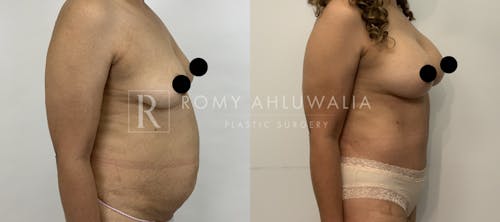 Before & After Result of Tummy Tuck Patient #31