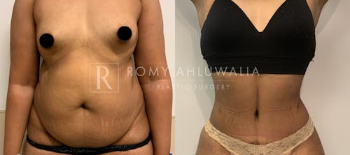 Before & After Result of Tummy Tuck Patient #4