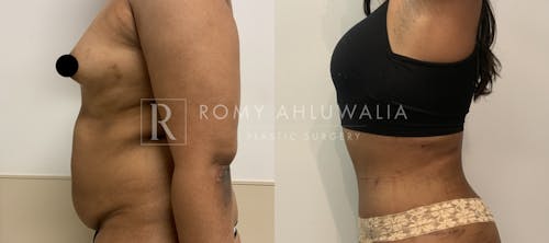 Before & After Result of Tummy Tuck Patient #4