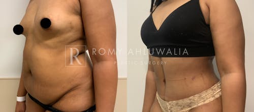 Before & After Result of Tummy Tuck Patient #4
