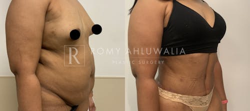 Before & After Result of Tummy Tuck Patient #4