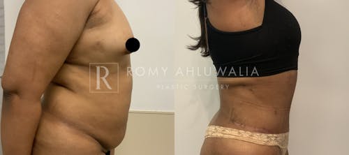 Before & After Result of Tummy Tuck Patient #4