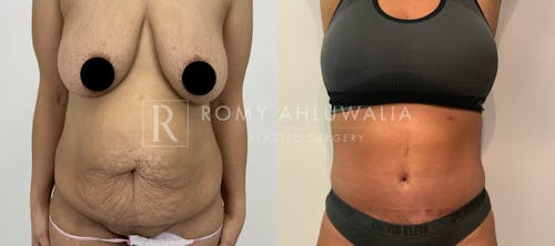 Before & After Result of Tummy Tuck Patient #32
