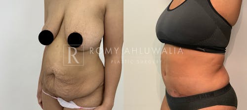 Before & After Result of Tummy Tuck Patient #32