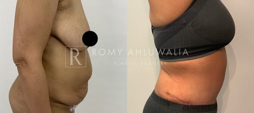 Before & After Result of Tummy Tuck Patient #32
