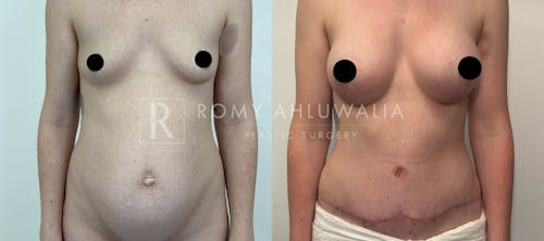 Before & After Result of Tummy Tuck Patient #33