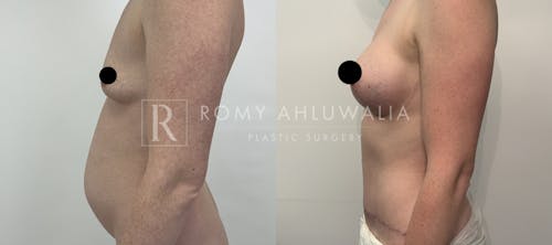 Before & After Result of Tummy Tuck Patient #33