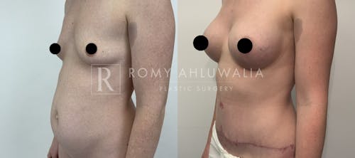 Before & After Result of Tummy Tuck Patient #33