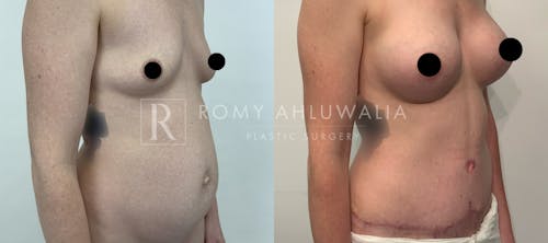 Before & After Result of Tummy Tuck Patient #33