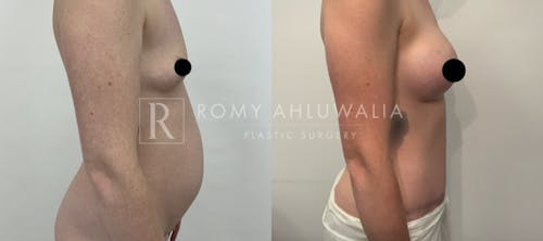 Before & After Result of Tummy Tuck Patient #33