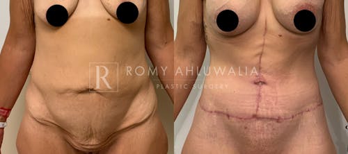 Before & After Result of Tummy Tuck Patient #35