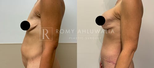 Before & After Result of Tummy Tuck Patient #35