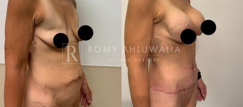 Before & After Result of Tummy Tuck Patient #35
